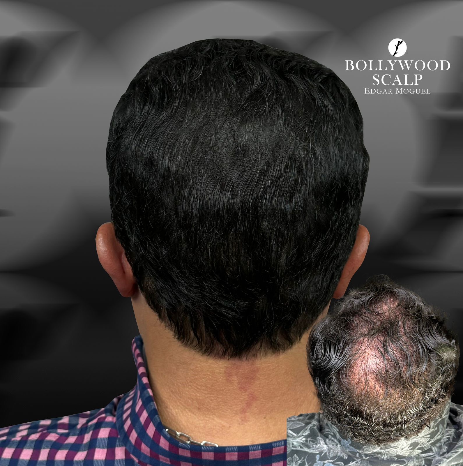 Resultado Masculino - Vista Posterior Antes y Después