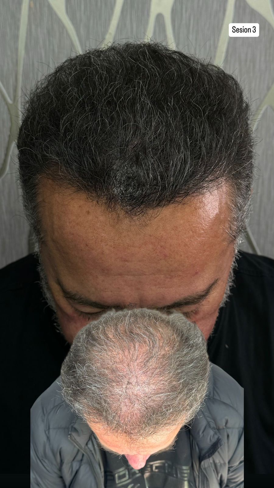 Micropigmentación Capilar - Sesión 3 Frontal