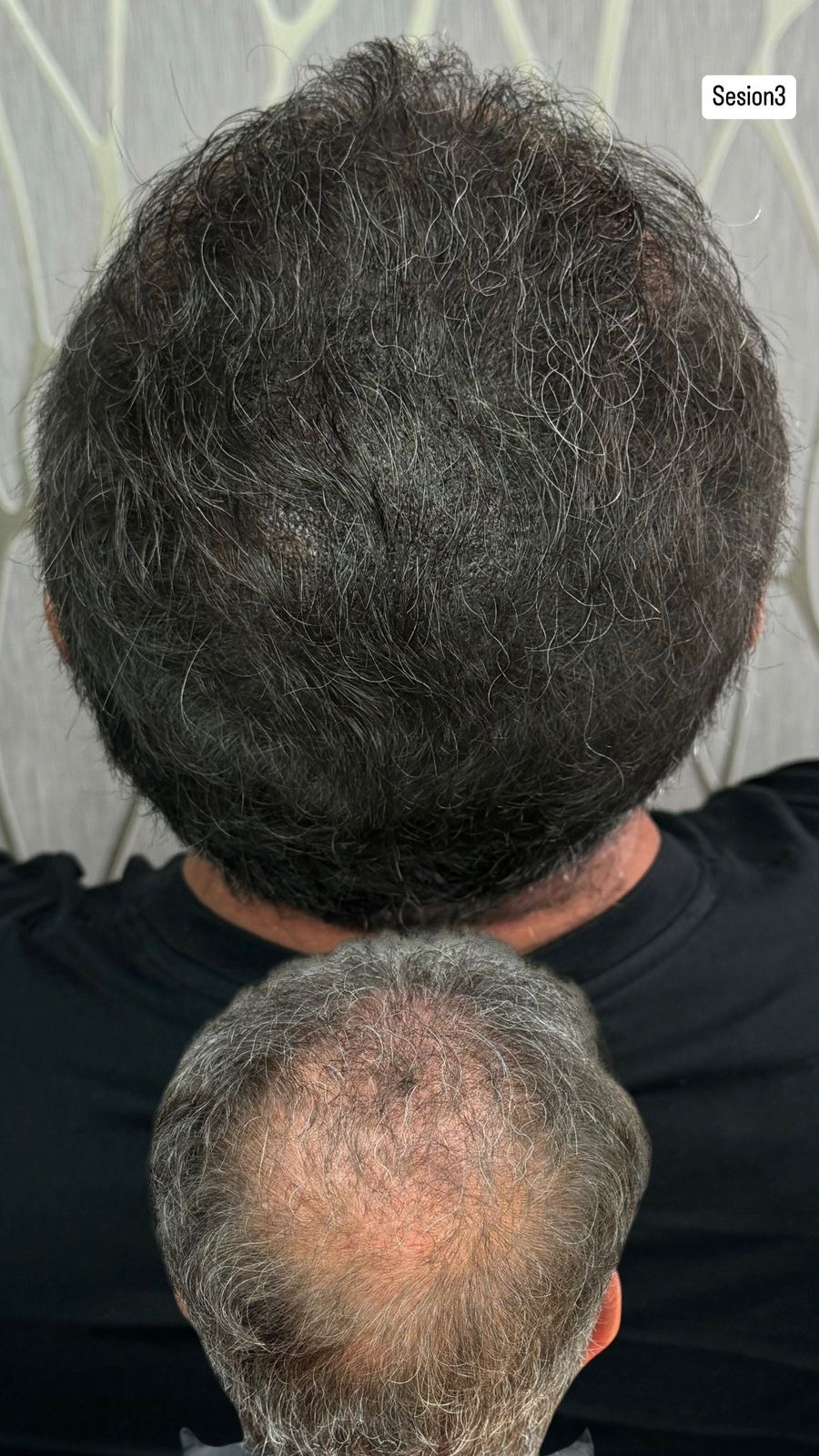 Micropigmentación Capilar - Sesión 3 Corona