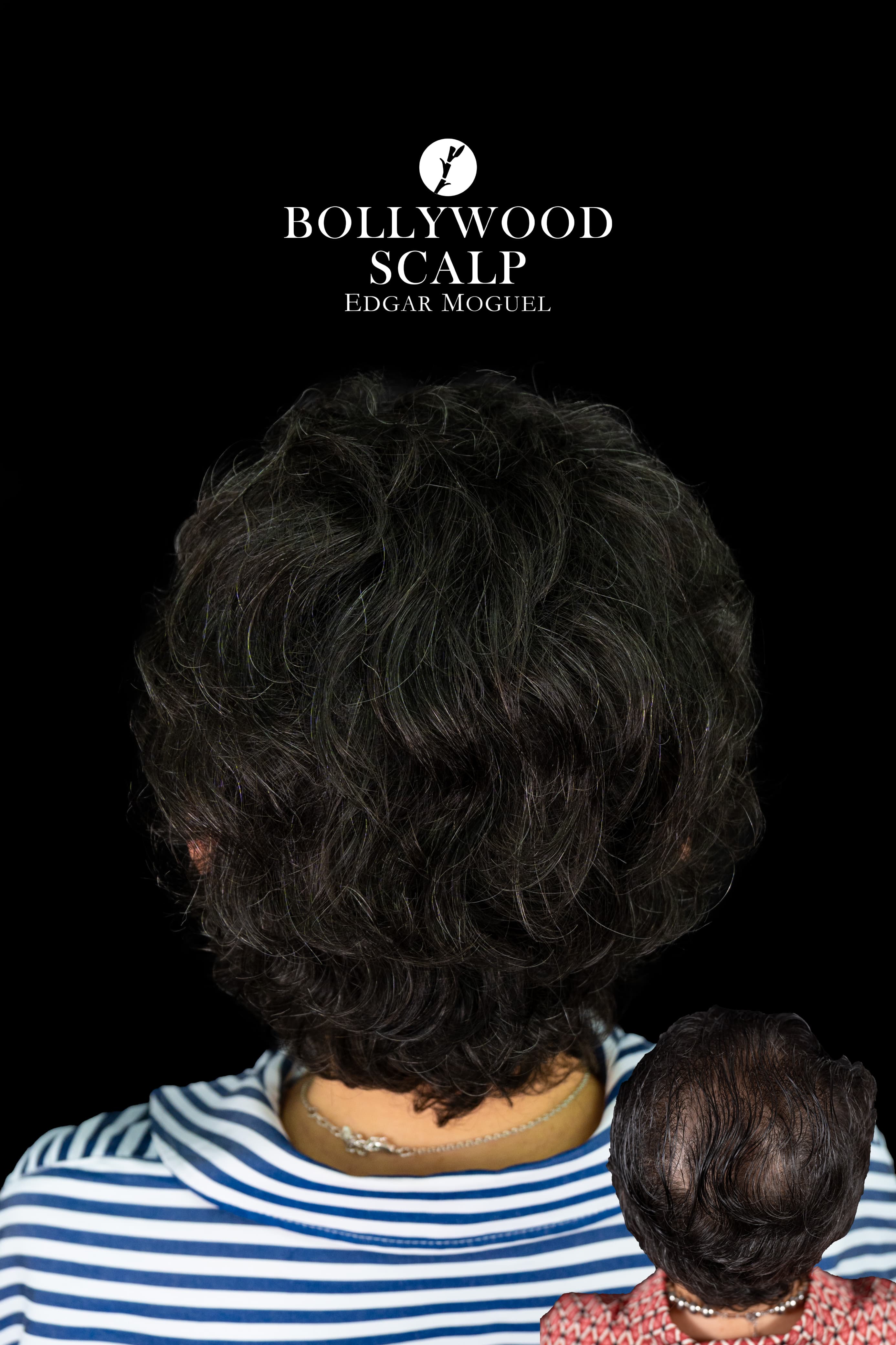 Resultado Capilar Femenino - Vista Posterior